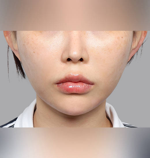 인중리프팅 Before & After