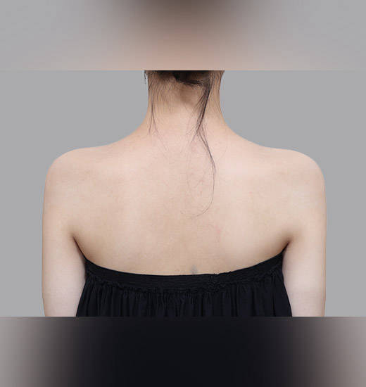 어깨필러 Before & After