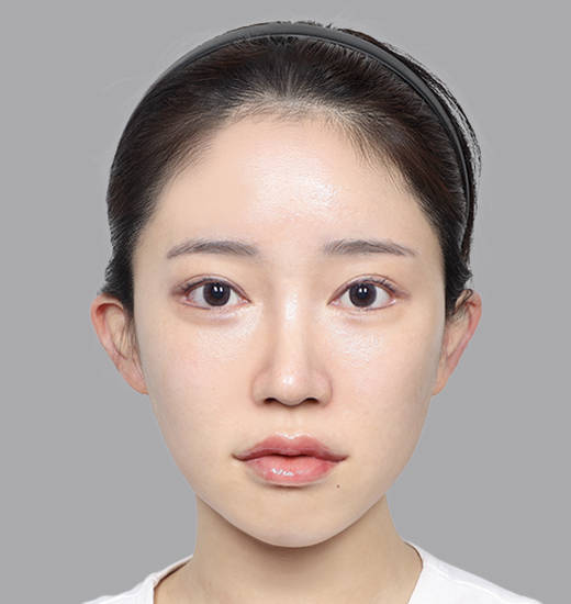 귀필러 Before & After