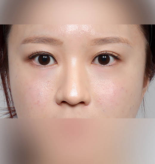 비절개 눈밑지방재배치 Before & After