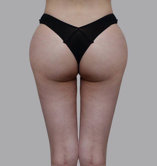 골반필러 Before & After