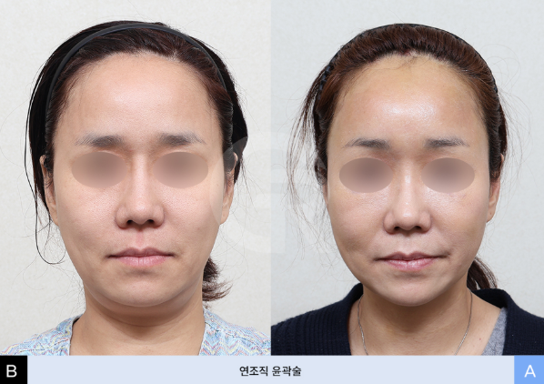 연조직윤곽술이란? 얼굴이 커 보이는 이유, 꼭 뼈 때문만은 아닙니다