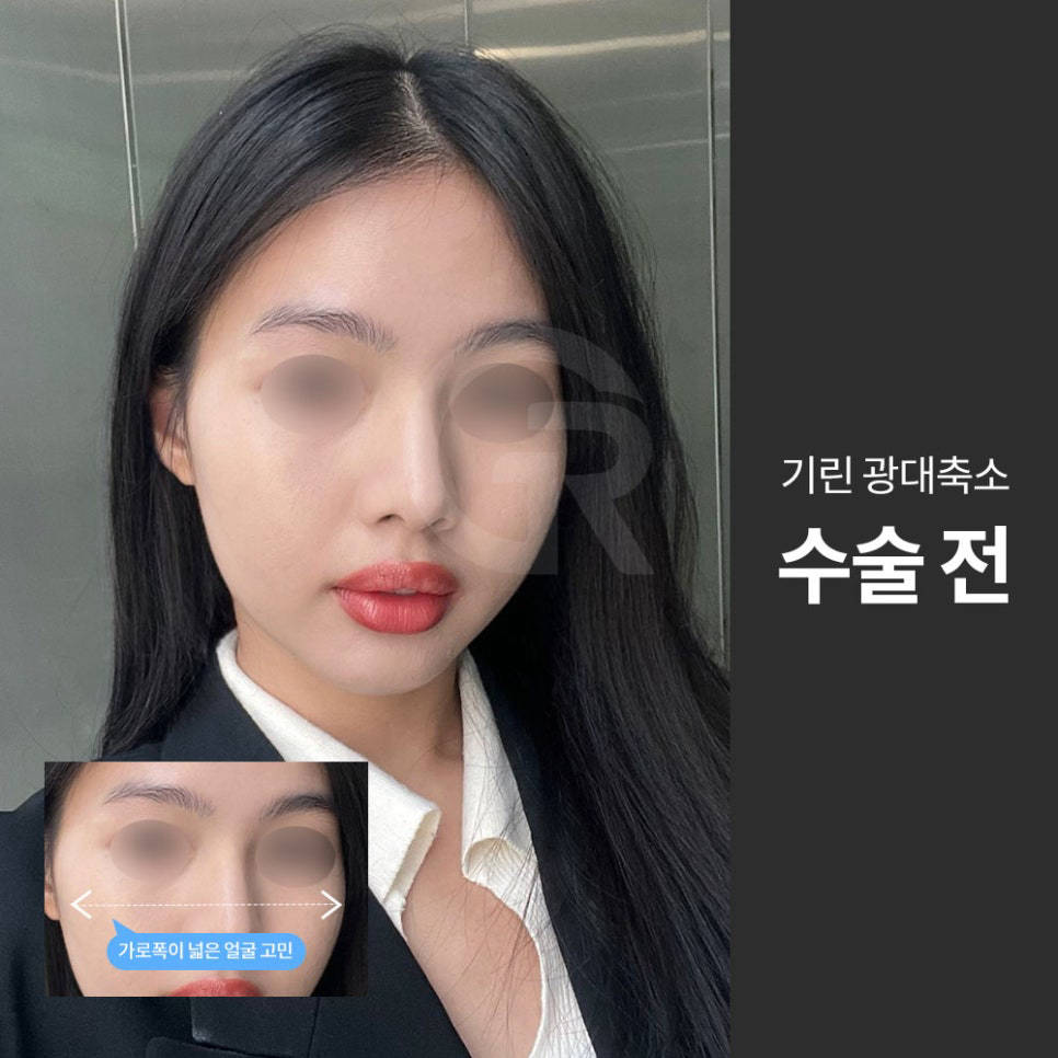 광대축소술, 옆광대·45도 광대와 볼처짐을 함께 고려해야 하는 이유