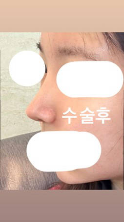 기린성형외과 코수술 3주차 후기 가져왔어요 !☺️