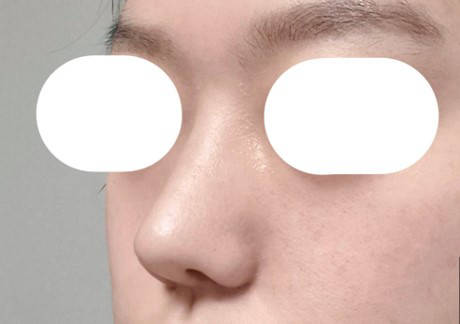 기린성형외과 코수술 벌써 2달차