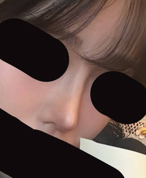 기린성형외과코수술맛집 수술 3개월 째