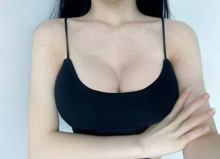 가슴성형 멘엑 2개월차 후기