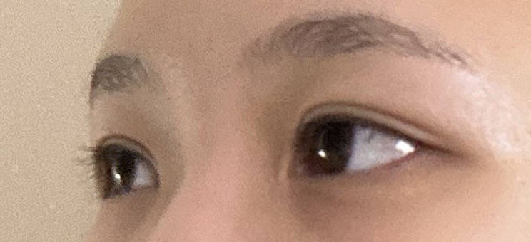 기린성형외과에서 아는언니 따라 수술했어요~