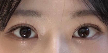 기린성형외과 절개로 수술했는데 붓기 거의 ❌❌❌