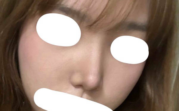 기린성형외과 낮은코 수술후기 가져왔어요!