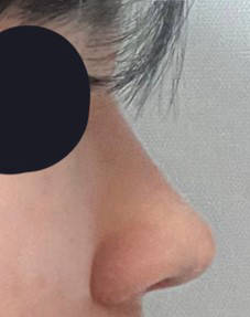 기린성형외과 매부리있는 코 사라졌어요!