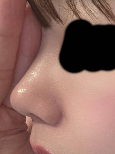 기린성형외과 코수술대만족 후기