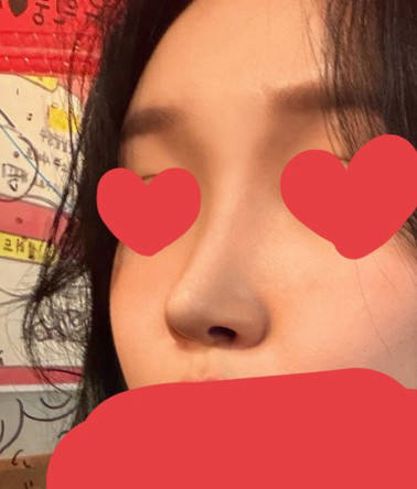 젤리코 수술 한 달 후기, 원장님 말 듣길 잘한 것 같아요